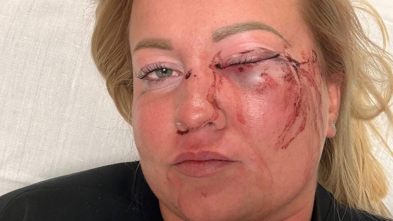 „Lehet, hogy soha többé nem fogok látni a bal szememre” – Gréta azt mondja, hogy megverte a szentmártonkátai alpolgármester a kolbásztöltő fesztiválon